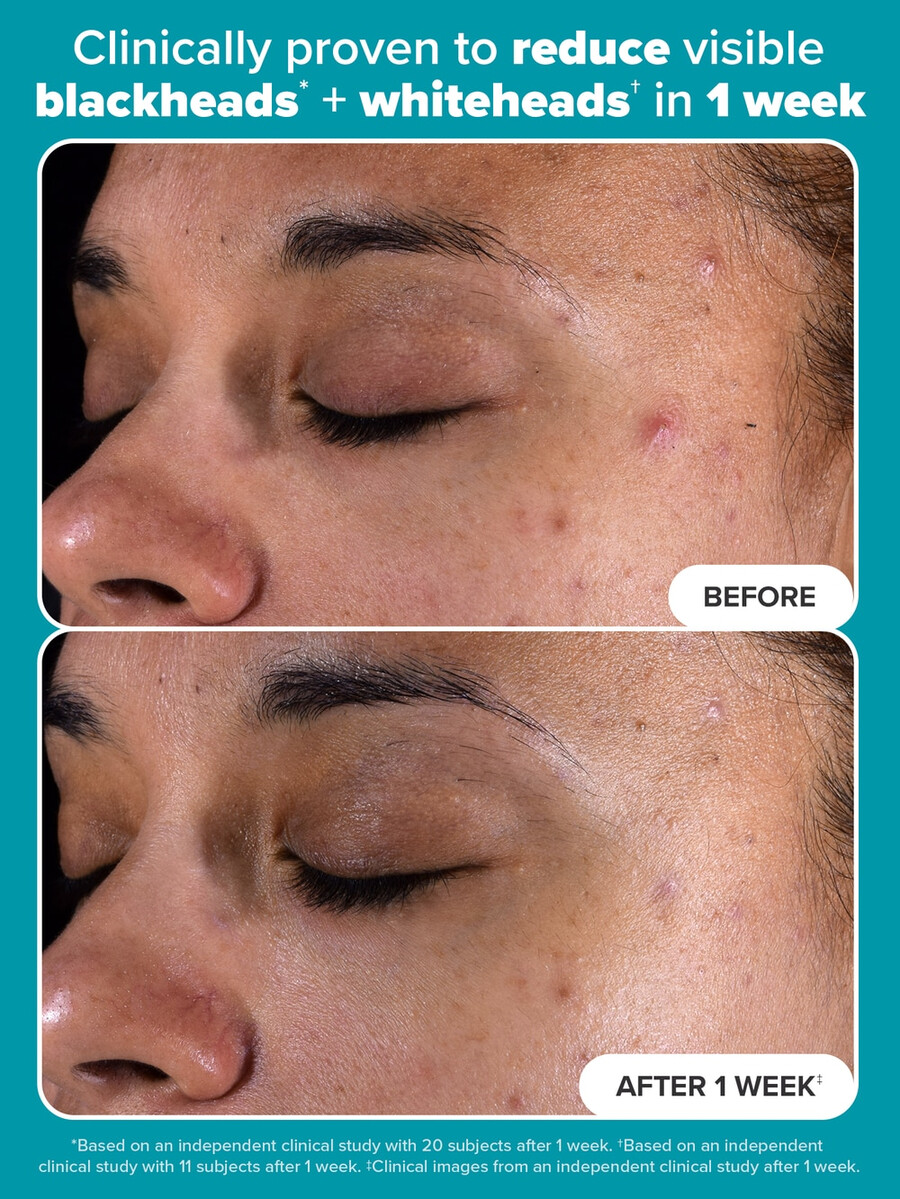 hudperfektering 2 bha flytande exfoliering