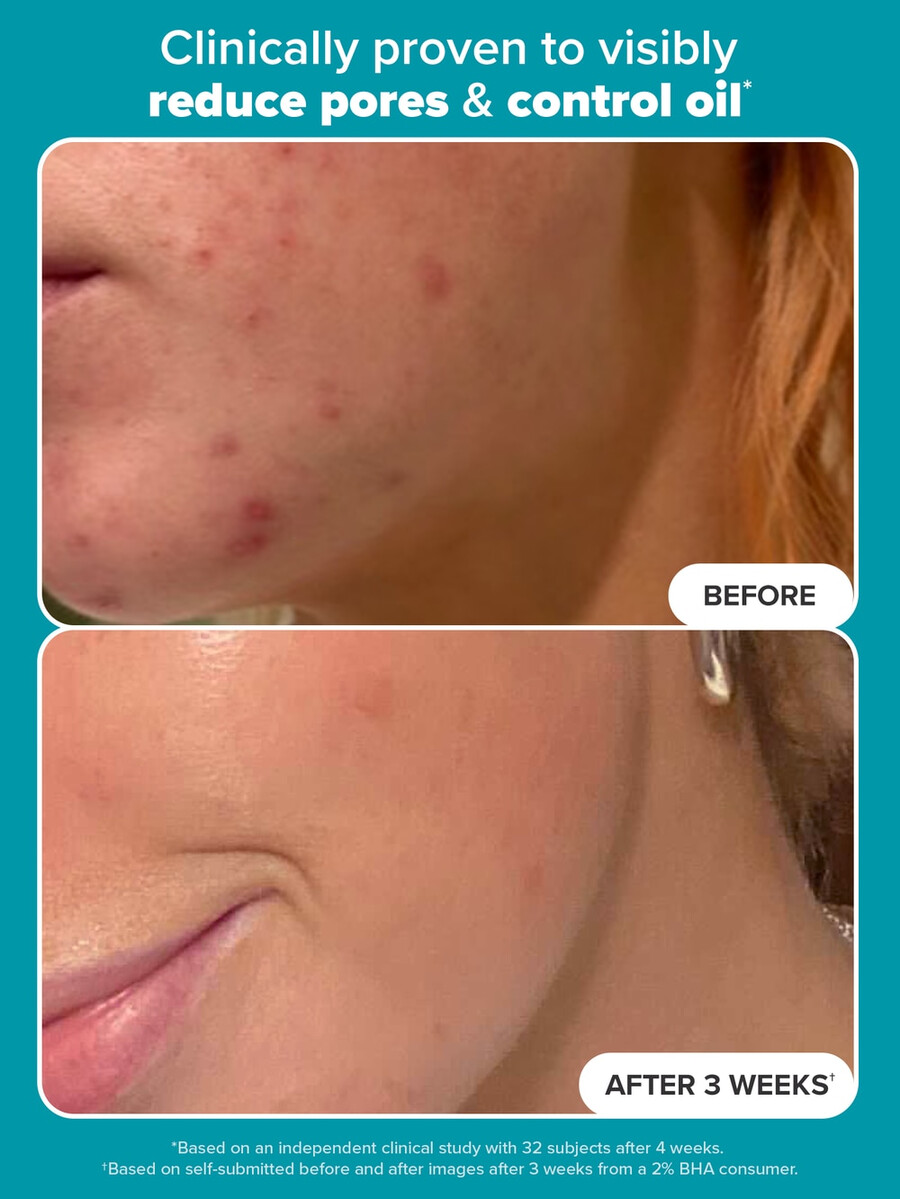 hudperfektering 2 bha flytande exfoliering
